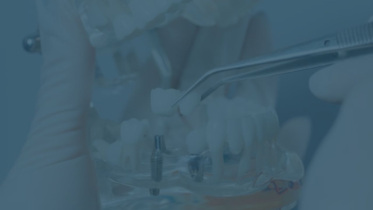 19_CARREGA_IMMEDIATA Implantes de carga inmediata en un dia