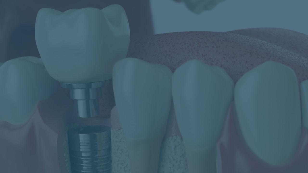 Implants dentals