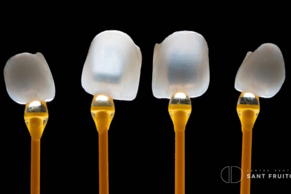 tipos-de-carillas-dentales