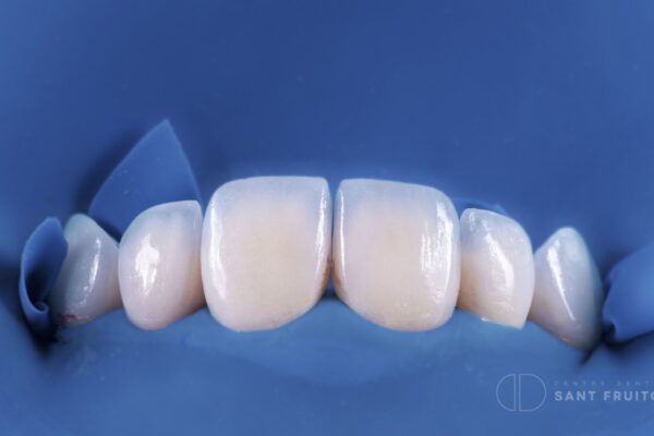 carillas-de-composite-manresa-sant-fruitos