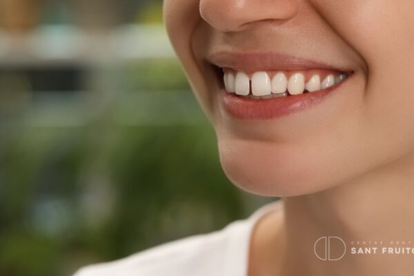 carillas-dentales-para-espacios-entre-dientes-manresa