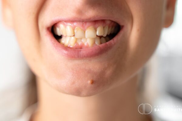 dientes-manchados-tetraciclinas-manresa-sant-fruitos