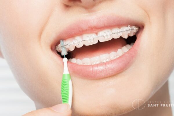 ortodoncia estética