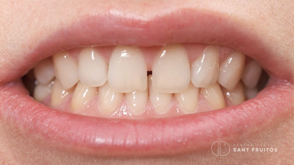 Diastemas tratamiento