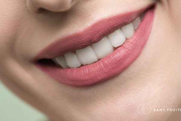 Diseño sonrisa con carillas