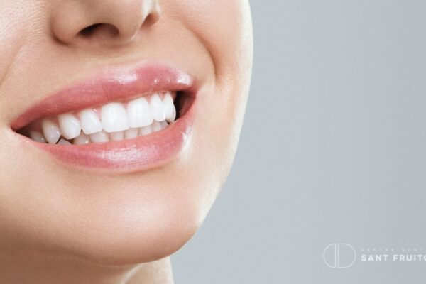 Manchas en los dientes