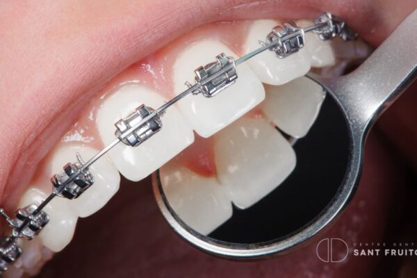 Ortodoncia interceptiva